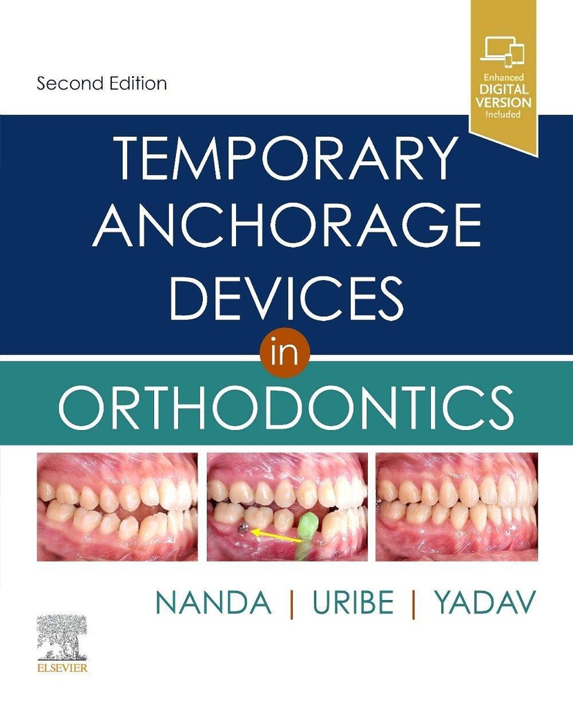 Temporary Anchorage Devices in Orthodontics: 2ed