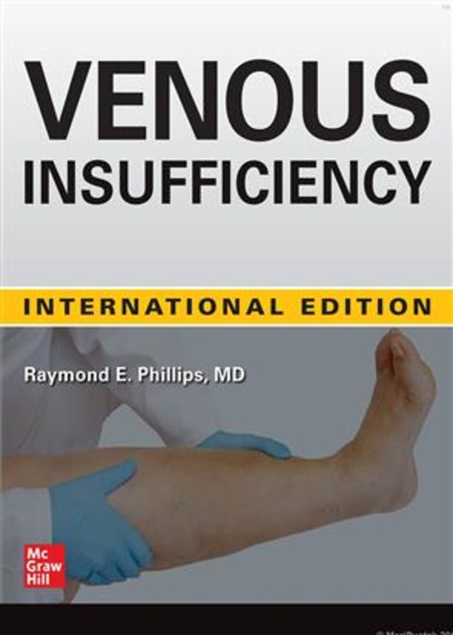 VENOUS INSUFFICIENCY (IE)