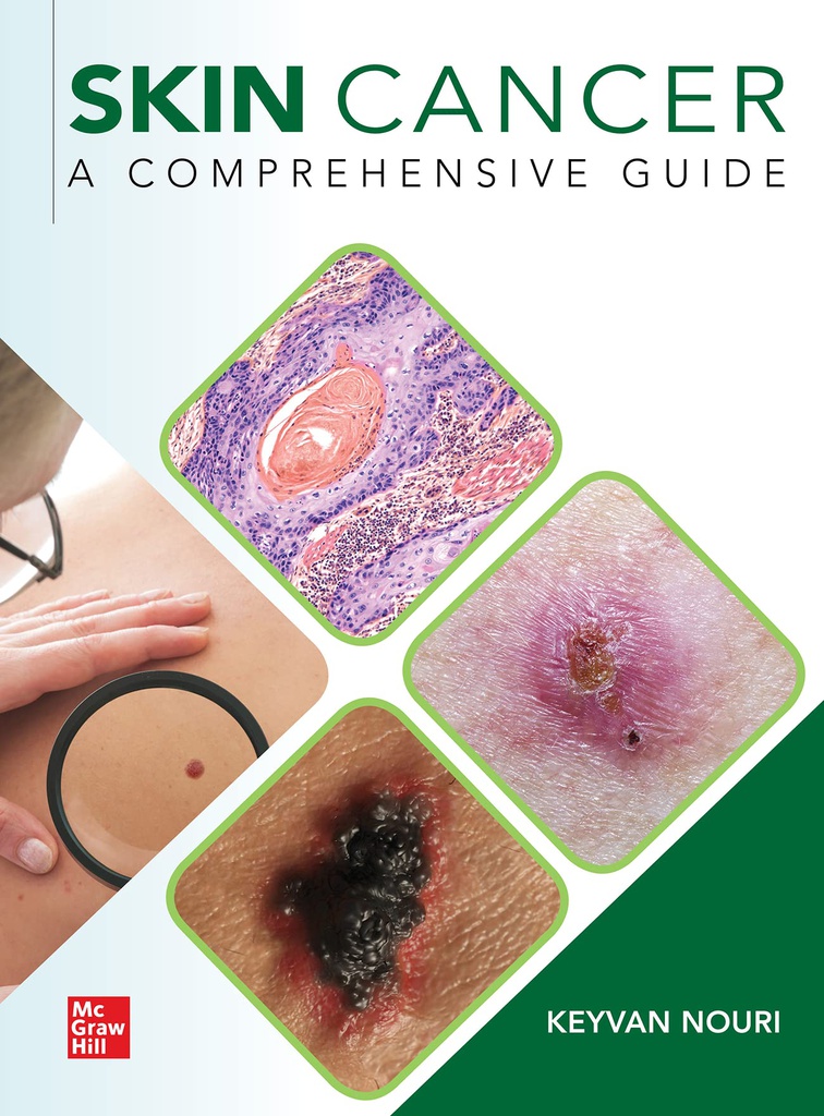 SKIN CANCER: A COMPREHENSIVE GUIDE