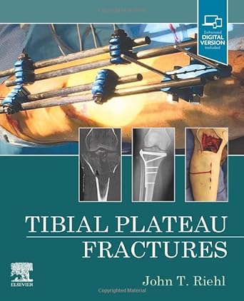 [B9780323825689] Tibial Plateau Fractures: 1ed