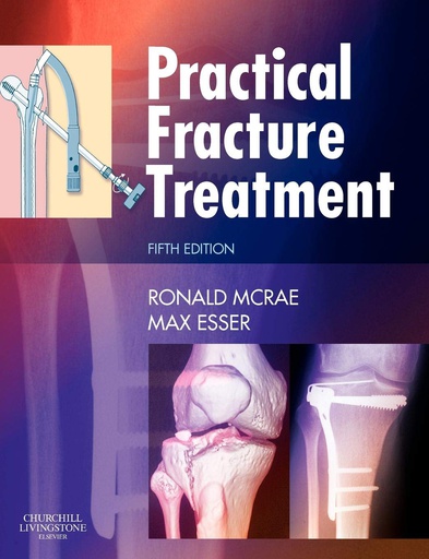 [B9780443068768] Practical Fracture Treatment: 5ed